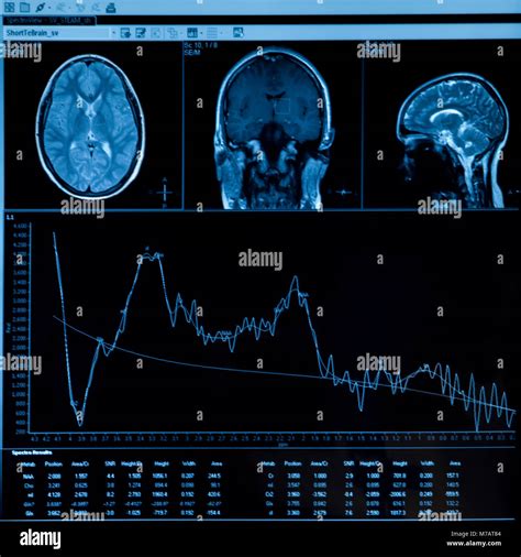 Close-up of MRI scan report Stock Photo - Alamy