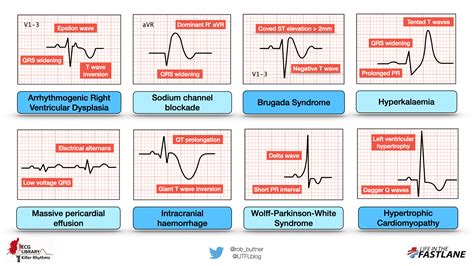 Killer ECG Patterns: Part • LITFL • ECG Library, 52% OFF