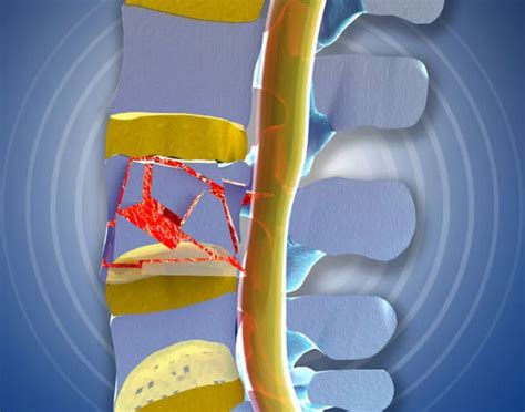 Thoracic Burst Fracture Treatment - EsHealthTips