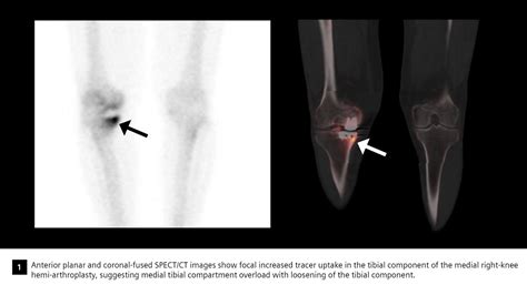 Loosening of tibial component of knee arthroplasty with medial impression fracture defined by ...