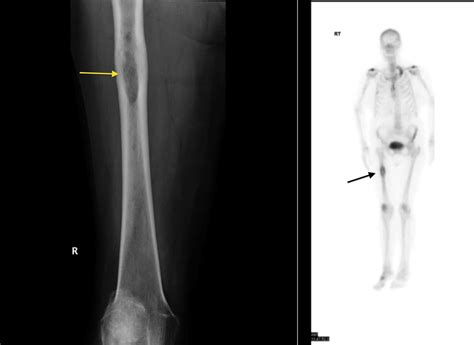 Bone metastasis - Radiology at St. Vincent's University Hospital