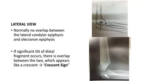 Cubitus valgus varus | PPT