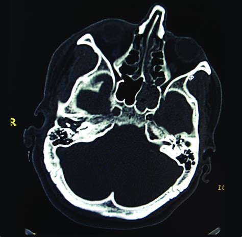 Axial CT shows the longitudinal fracture of the right temporal bone and... | Download Scientific ...