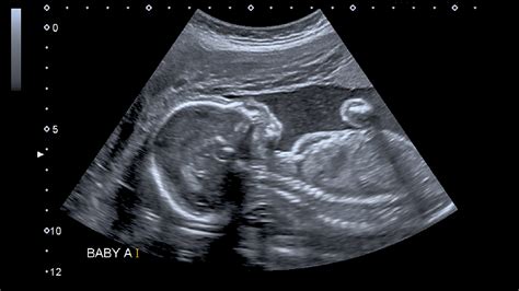 Alabama judge allows teen to sue on behalf of aborted fetus | Fox News