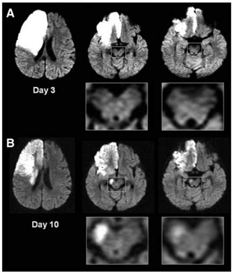 Historical perspective on MRI Characteristics of Wallerian Degeneration ...