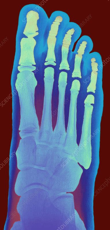 Child's foot, X-ray - Stock Image - P116/0791 - Science Photo Library