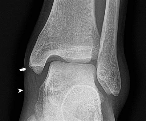 Cureus | Radiographic Imaging of Parachuting-Related Ankle Fractures ...