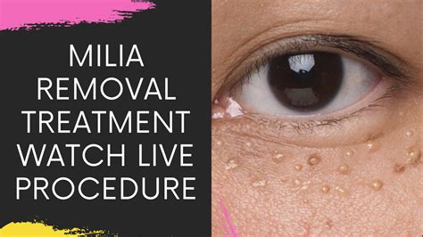 Milia Removal Treatments In Navi Mumbai | Milia Eyelid | Milia