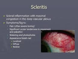 Image result for scleritis | Eye Health | Eyes problems, Optometry, Eye ...