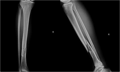 Preoperative tibia radiograph. The radiograph shows spiral oblique ...