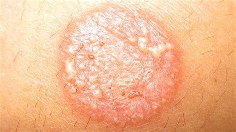 Tinea Corporis (Body Ringworm): Treatment and More