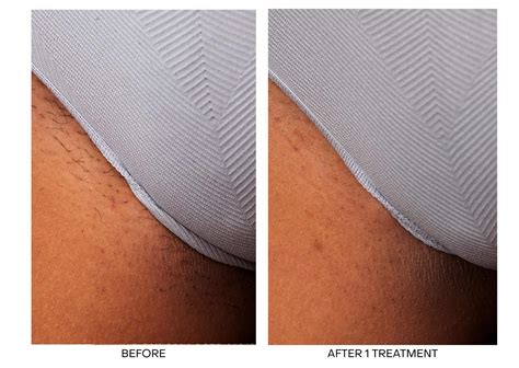 Best Laser Hair Removal Near Me | Laser Hair Removal Hamilton | Hair Removal Hamilton