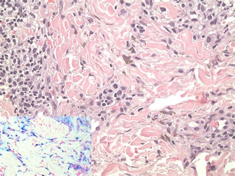 Isotretinoin-Induced Facial Hyperpigmentation: Idiosyncratic Reaction ...