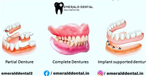 TYPES OF DENTURES - EMERALD DENTAL