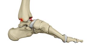 Ankle Impingement Stirling, UK | Anterior Ankle Replacement London UK