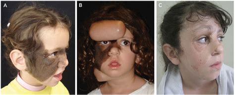 RBCP - Therapeutic options in the management of giant congenital nevus ...