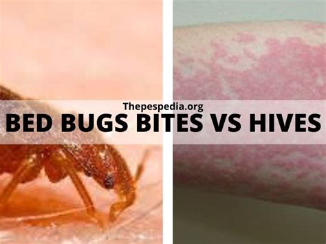 Bed Bug Vs Flea Bites