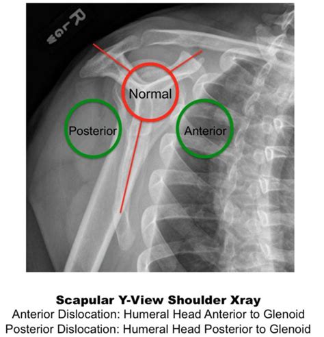 scapular “Y” view - Поиск в Google | Medical radiation technologist ...