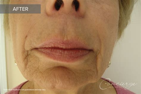 B and A Photos - JUVÉDERM Ultra Lips (70 yo Female) | Concierge Aesthetics