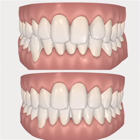 Invisalign Invisible Braces | Clear Braces | Invisalign Cost