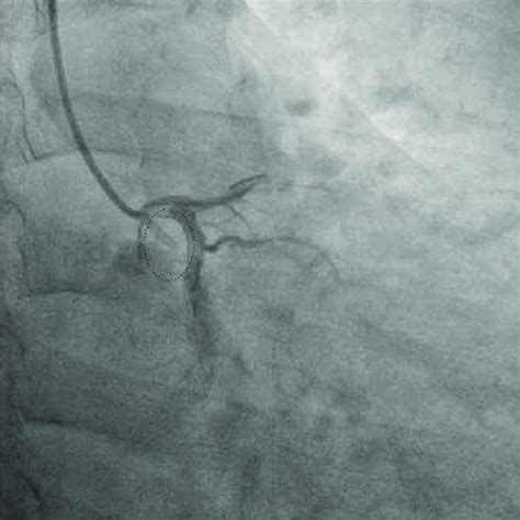 Coronary angiography with a catheter located in the coronary artery. e ...