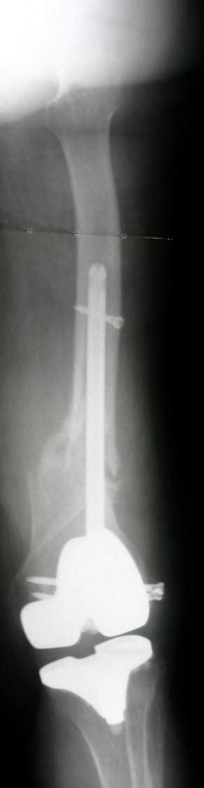 Periprosthetic Fracture: Femur Case 1 - Dr. Mark Brinker, Houston ...