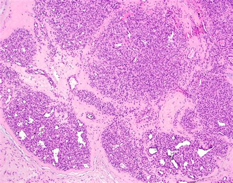 Oral Pyogenic Granuloma Histology