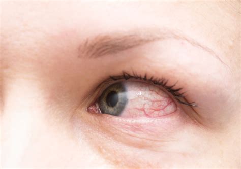 Red Eyes Symptoms Of Diabetes - DiabetesWalls