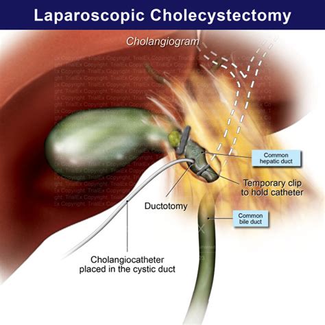 Laparoscopic Cholecystectomy: Cholangiogram - TrialExhibits Inc.