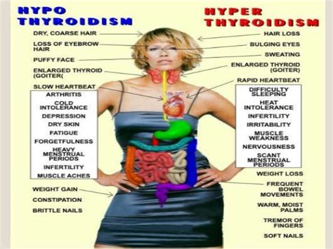 Hashimoto’s thyroiditis