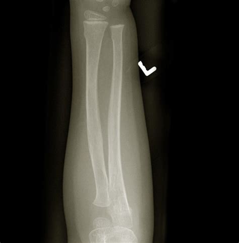 Greenstick Fracture - Pictures, Treatment, Symptoms, Healing Time ...