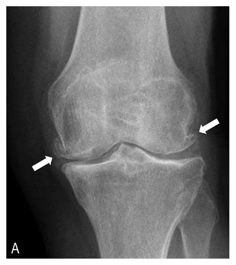 Knee Osteoarthritis: A Primer | The Permanente Journal