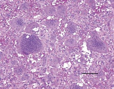 Histology of the tumor consists of osteoclast-like giant cells... | Download Scientific Diagram