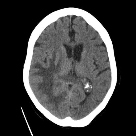 Vasogenic cerebral edema | Radiology Reference Article | Radiopaedia.org