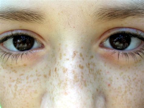 Freckles vs Lentigines: What is the difference in two? - Medicalopedia