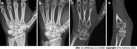 Unusual capitate fracture with dorsal shearing pattern and concomitant ...