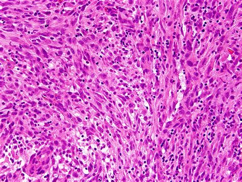 Pathology Outlines - Gliosarcoma