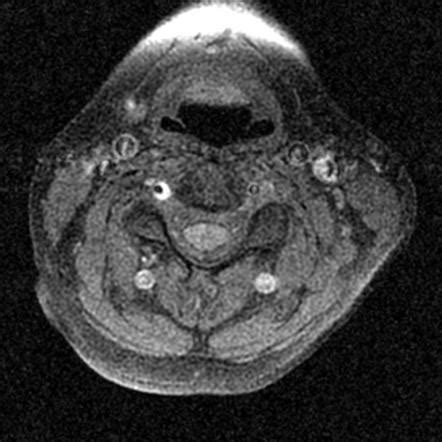 Vertebral Artery Ct Scan