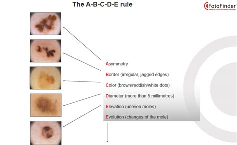 Mole Mapping | Cayman Doctors