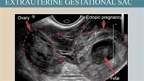 How to Identify Ectopic #Pregnancy Signs On Ultrasound - #YouTube https://www.youtube.com/watch ...