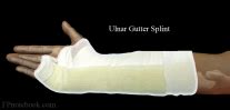 Ulnar Gutter Splint