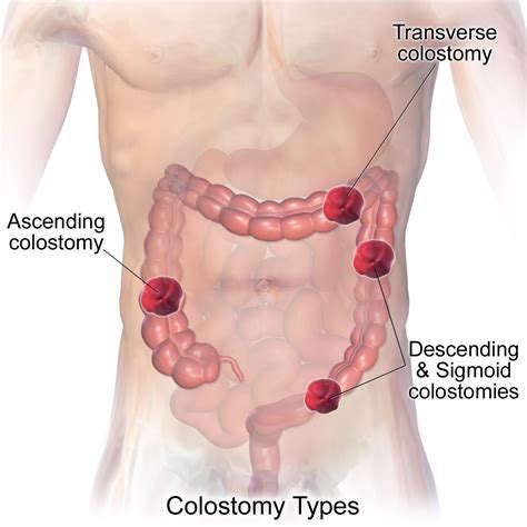 Colostomy - How To Change A Colostomy Bag & Living With It