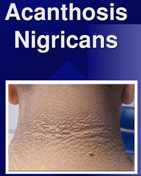 7 best Acanthosis Nigricans/Diabetes Resources images on Pinterest ...