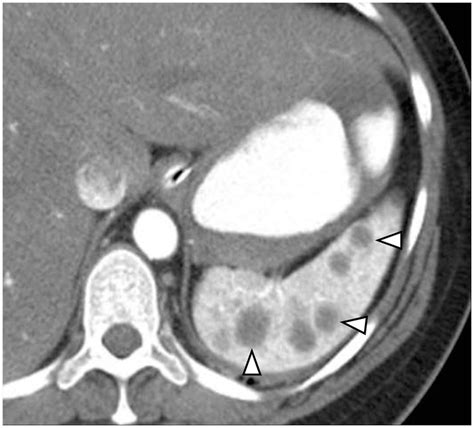 Peliosis of spleen. Contrast-enhanced CT shows multiple hypodense ...