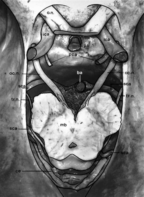 Meningiomas of the tentorial notch: surgical anatomy and management in: Journal of Neurosurgery ...