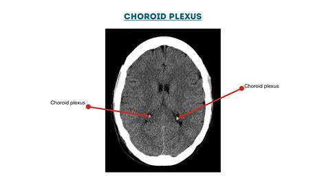 Choroid plexus diagram | Geeky Medics