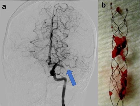 a Cerebral angiogram from a young patient with an acute ischemic stroke ...