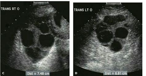 Transverse images of the (C) right and (D) left ovaries reveal multiple theca lutein cysts ...