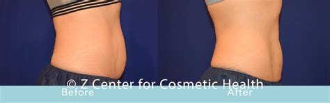 Coolsculpting Abdomen Before & After #36 - Zcosmetic Health