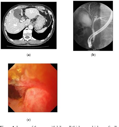 Figure 1 from Endoscopic Diagnosis of Biliary Stricture Combined with ...